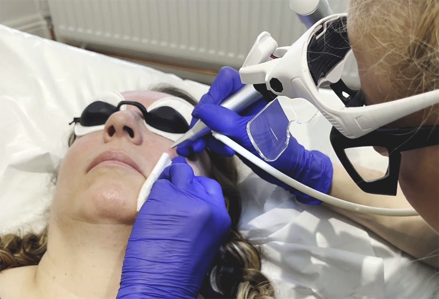Laser skin treatment